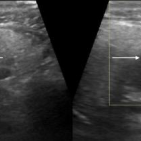 B mode ultrasound of right parotid gland