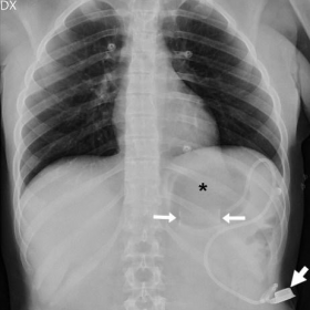 Plain abdominal radiograph - supine (a) and tangential (b) views