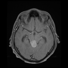 MRI axial T1 Post Gd