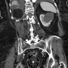Initial abdominopelvic CT at admission