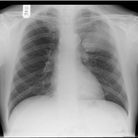 Chest X-Ray.