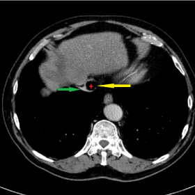 Contrast-enhanced CT-abdomen, axial image