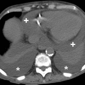 Pre-thoracentesis unenhanced chest CT
