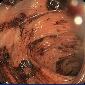 Endoscopic view of colon