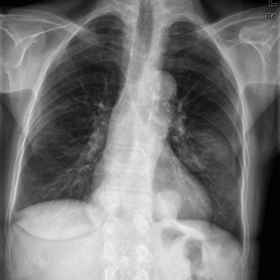 Preoperative chest radiograph