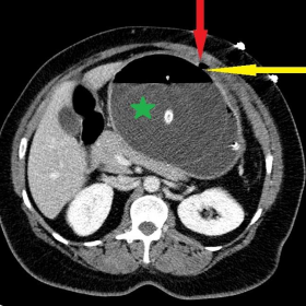 Contrast-enhanced CT of the abdomen