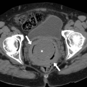 Urgent unenhanced and post-contrast CT