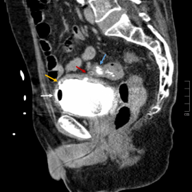 CT cystography – Reconstructed sagittal CT image