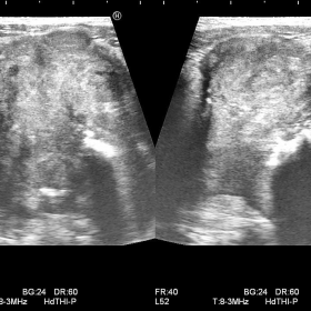 Grey scale ultrasound image