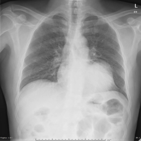 Postero-anterior chest x-ray