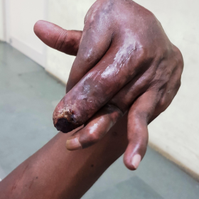 photograph of the hand of the patient