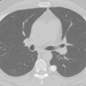 Axial CT Lung