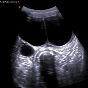 Ultra-sonography of thigh