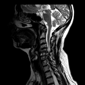Cervical spine MRI