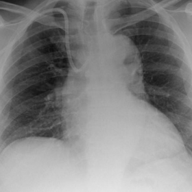 PA chest radiograph with a right sided tunnelled dialysis catheter.