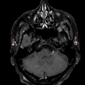 Axial 3.0 Tesla contrast-enhanced T1-weighted Black-Blood imaging