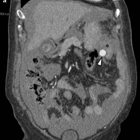 Abdominopelvic CT angiography in coronal plane.