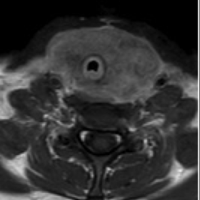 Pre-treament MRI of the neck showing tracheal compression