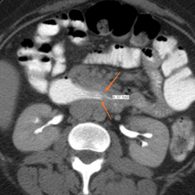 Abdominal CT examination, axial image – showing classic “wind-sock”
