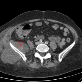 CT abdomen and pelvis (axial view)