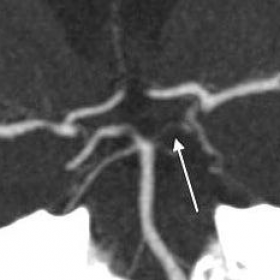 Left cerebral posterior artery occlusion