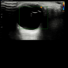 Left Eye Ultrasound