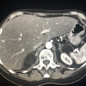 Figure 1:Axial CT
