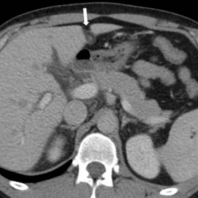 Abdominal CT - Axial images