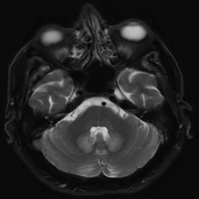 T2W and FLAIR MRI