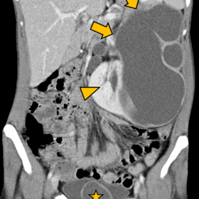 Contrast-enhanced CT in portal phase, coronal projection