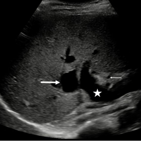 B-mode ultrasound