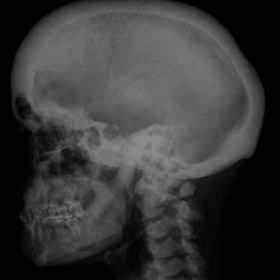 Lateral Skull Radiograph