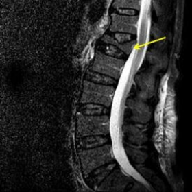 Sagital STIR sequence (lumbar spine)