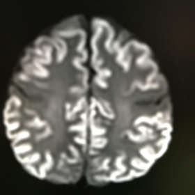 Axial Diffusion weighted images of the brain