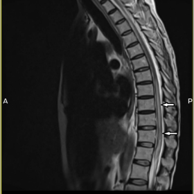 MRI DORSAL SPINE (PLAIN)