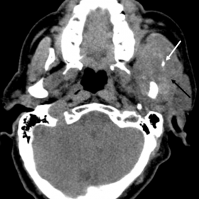 Axial pre-contrast CT images.