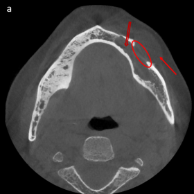 Cone Beam CT of the mandible