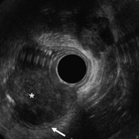 83-year-old man with primary anorectal melanoma. Endoscopic Ultrasonography.