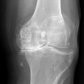 Plain radiographs of the knee (anteroposterior and lateral views)