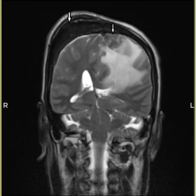 MRI BRAIN (PLAIN)
