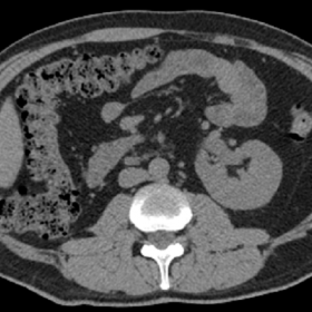 Axial slice of a non-enhanced CT scan of the abdomen