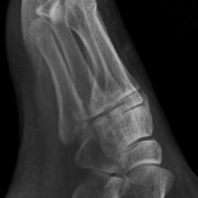 Lateral radiograph right foot.