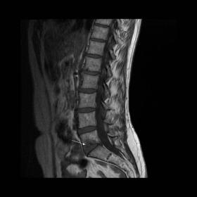 Sagittal MRI of lumbar spine
