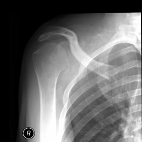Radiography of the right scapula