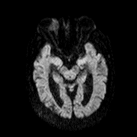 MRI of the brain and orbits