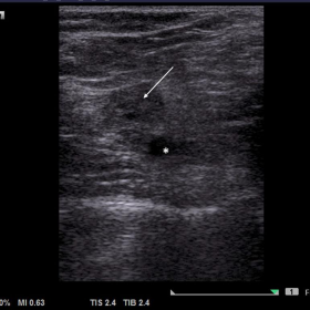 High resolution USG of posterior aspect of distal thigh