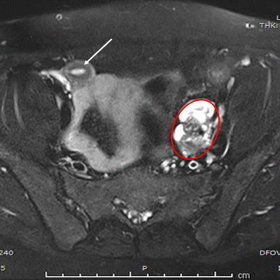 Axial T2W fat-sat image of the pelvis