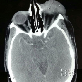 Contrast enhanced CT showing the conjunctival PNET