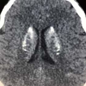 axial cut CT Brain