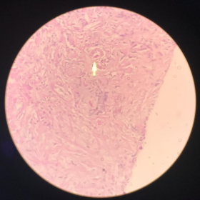 pathology image showing fungal hyphae